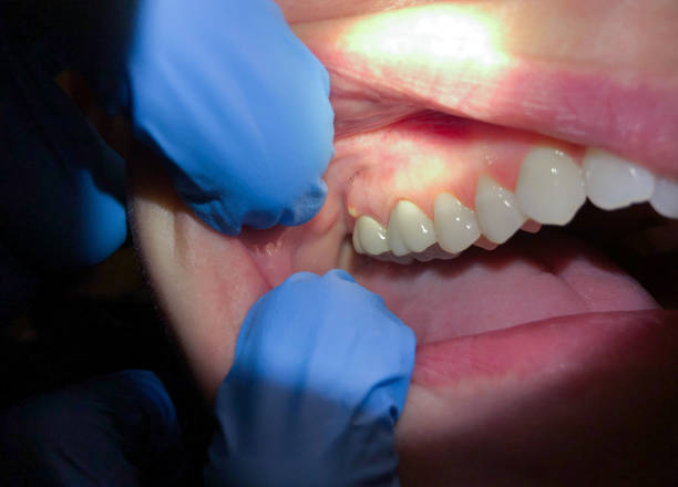 Best Emergency Dental Care for Abscessed Tooth in Pink, OK
